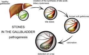 Gallbladder and gallstones