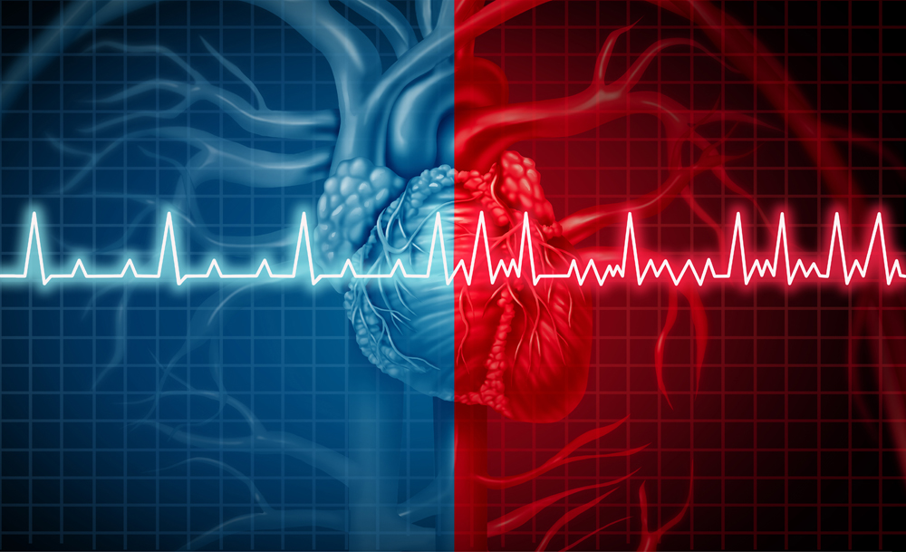 Atrial Fibrillation (AFib) compared with normal heart rhythm
