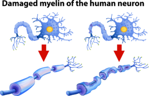 owing the progression of peripheral neuropathy and nerve degradation