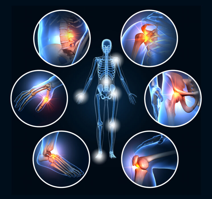 joints affected by inflammation and disfiguration by rheumatoid arthritis autoimmune disease