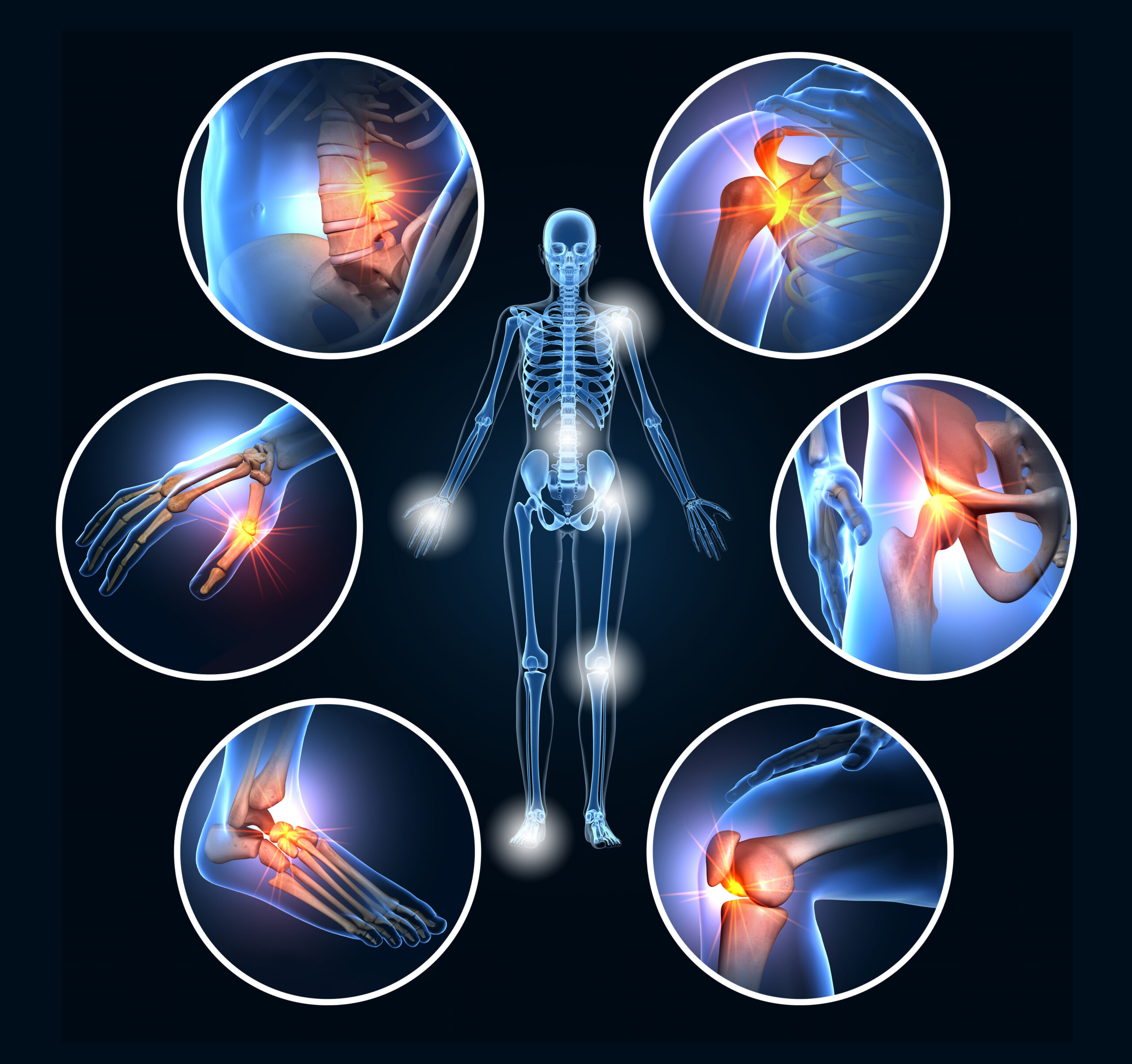joints affected by inflammation and disfiguration by rheumatoid arthritis autoimmune disease