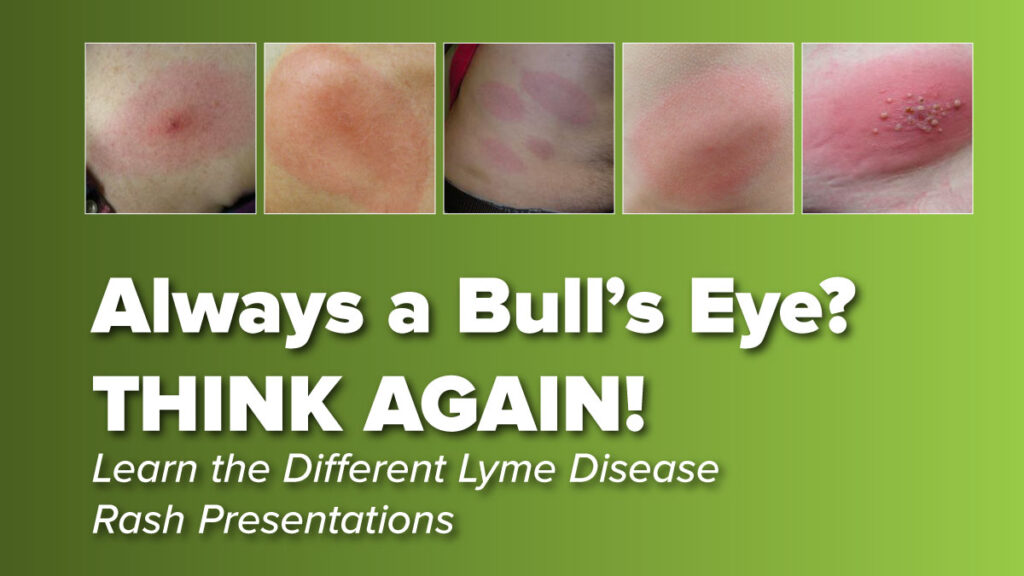 Lyme Disease always a bull's eye? Think again