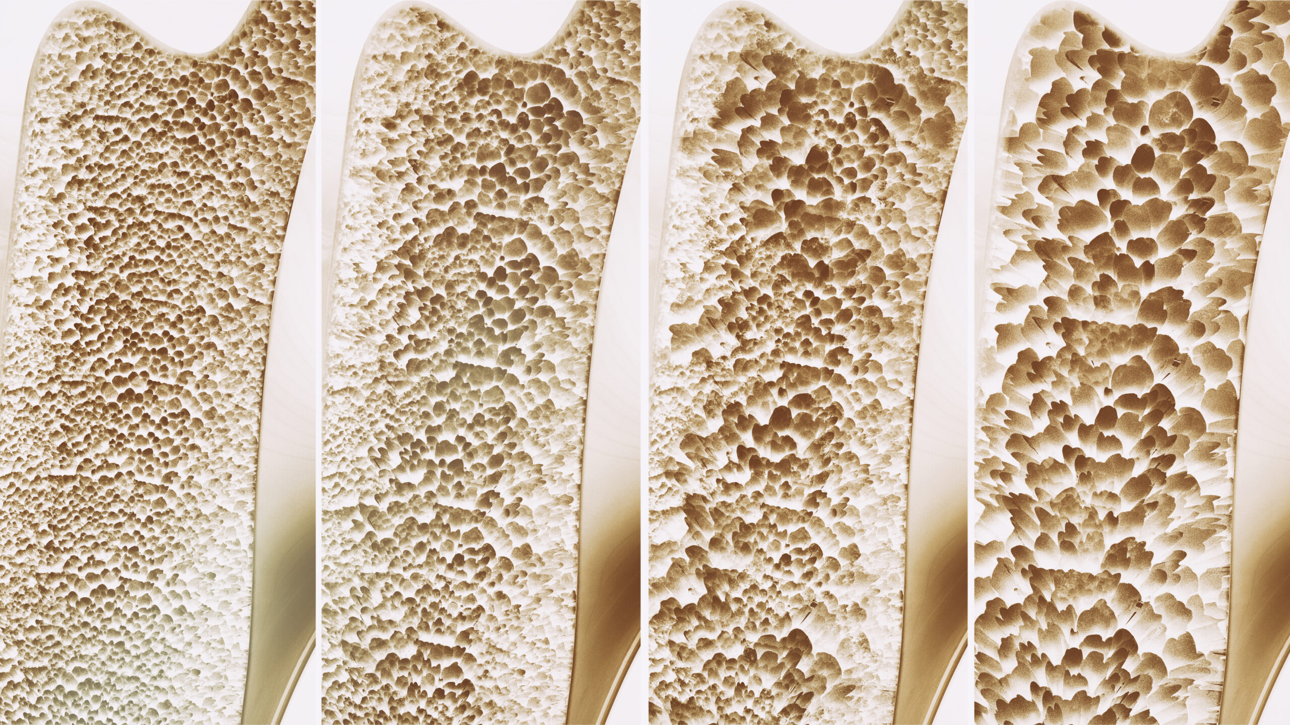 The stages through osteopenia to osteoporosis